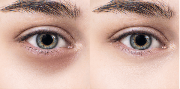 Cách trị quầng thâm mắt nhanh nhất hiệu quả trong 1 tuần cho nam giới