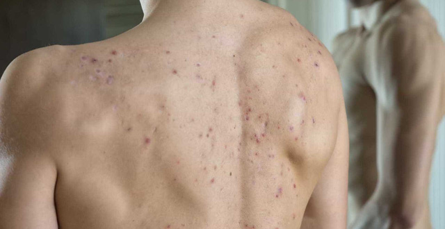 Nổi mụn lưng ở nam giới: Nguyên nhân và cách phòng tránh, điều trị hiệu quả